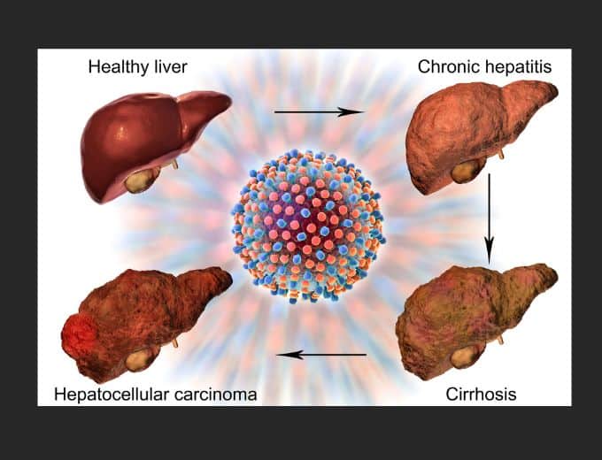 infographic about liver health